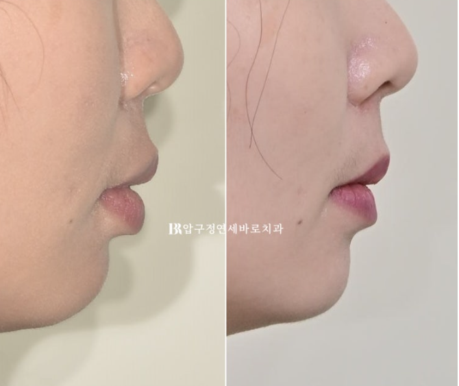 Does Invisalign Prevent Root Movement? Before-and-After Comparison of Extraction Treatment for Protruding Lips image 15