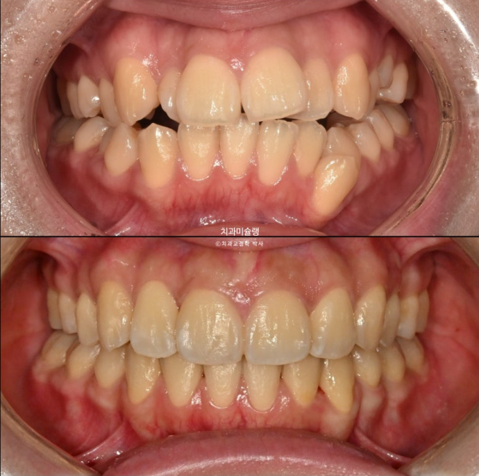 30대 인비절라인 덧니 발치교정 개방교합 치료 관련 이미지 21