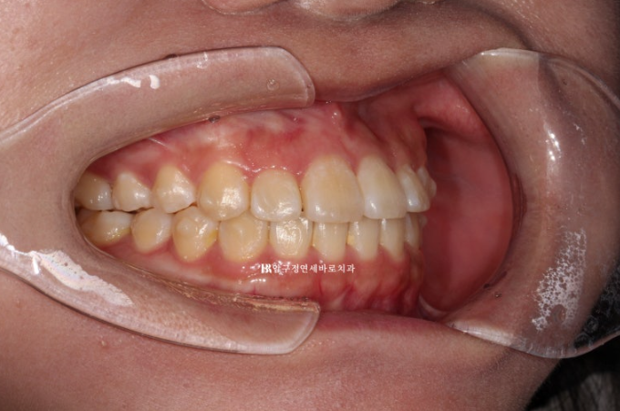 인비절라인라이트 재교정 뻐드렁니 교정 돌출 교정 관련 이미지 4