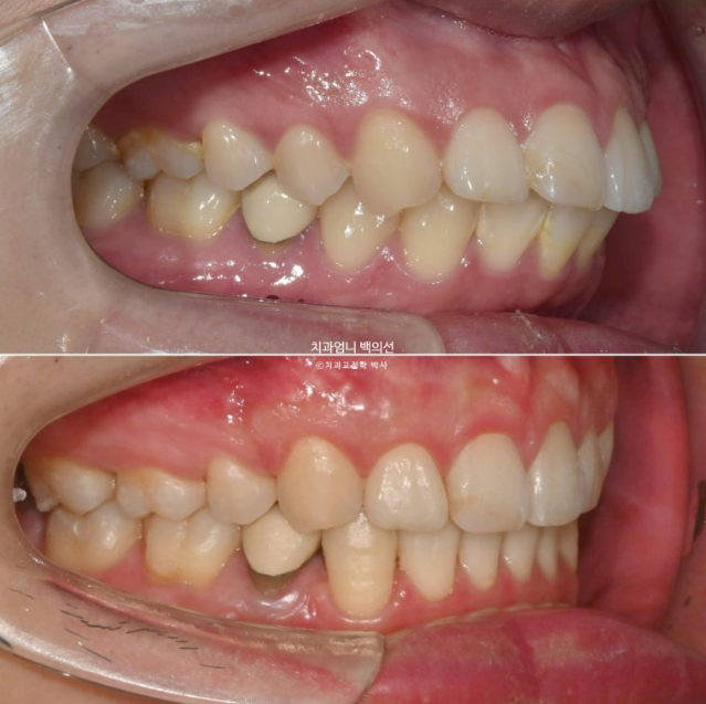 돌출입 발치 교정 인비절라인 후기 미니스크류 관련 이미지 1