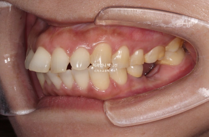40대 인비절라인 라이트 앞니 벌어짐 뻗침 돌출 치료 관련 이미지 4