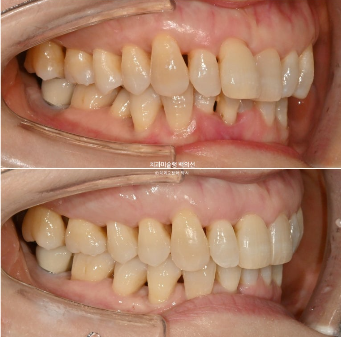50대 치아교정 중년 발치교정 블랙트라이앵글 치료 후기 관련 이미지 17