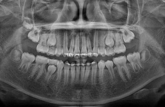 강남 소아교정 인비절라인 퍼스트 어린이 반대교합 관련 이미지 17