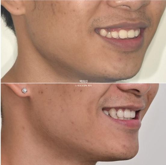 거미스마일 잇몸미소 발치 돌출입 과개교합 교정 후기 관련 이미지 15