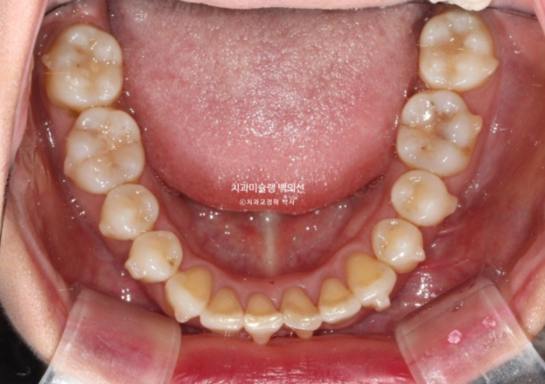 옥니 덧니 과개교합 반대교합 중심선 인비절라인 치료기간 1년 관련 이미지 10
