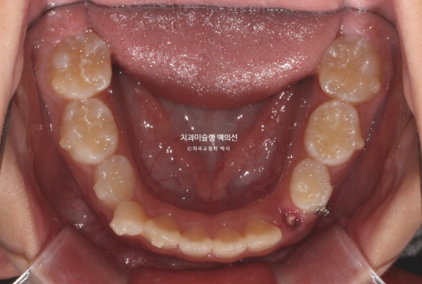 어린이 비대칭 반대교합 주걱턱 인비절라인 퍼스트 프리올소 성장 교정 관련 이미지 18