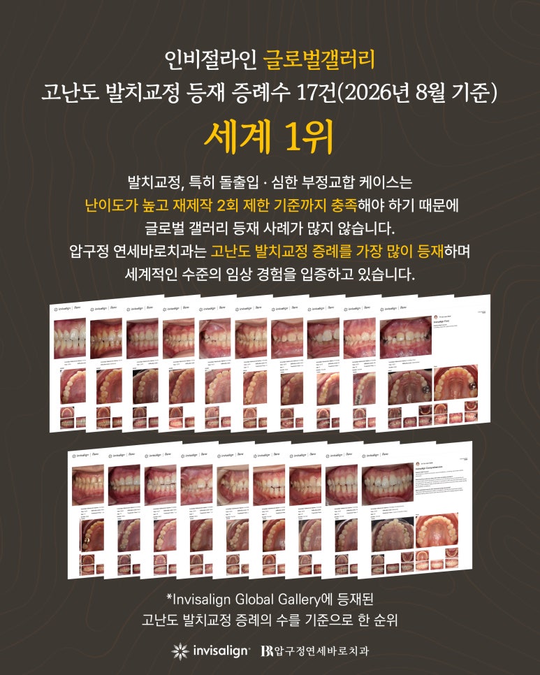 강남 인비절라인 발치교정에서 치아가 계획대로 움직이지 않는 이유는? 관련 이미지 1