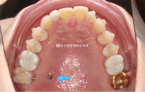 40대 인비절라인 라이트 가위교합? 관련 이미지 8