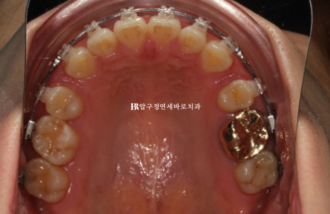 Gummy Smile Correction, Gummy Smile Orthodontics, Rabbit Teeth Correction image 6