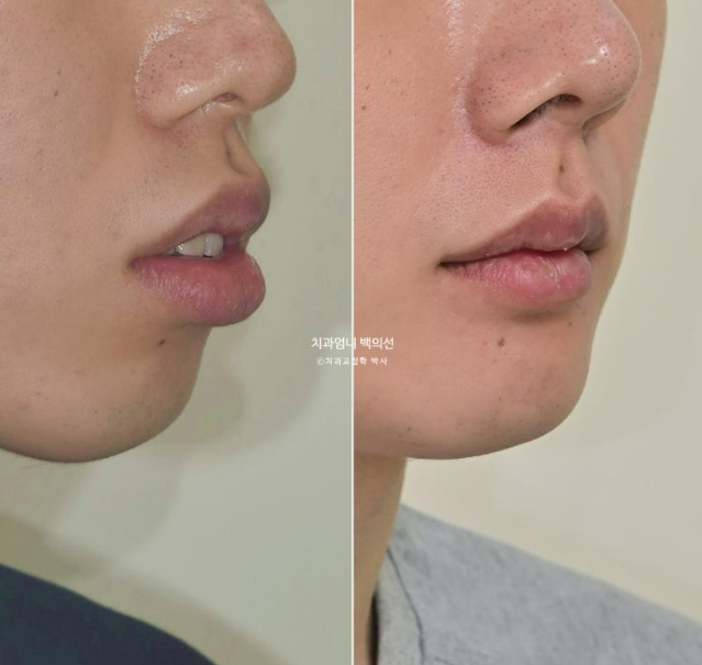 돌출입 발치 교정 인비절라인 후기 미니스크류 관련 이미지 24