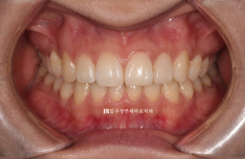 앞니 부분교정은 어떤 경우에 가능한가요? 단기 앞니 부분교정 왜소치 치료 무삭제 라미네이트 관련 이미지 9