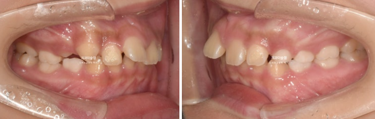 선천적 결손 잔존유치 과개교합 돌출입 인비절라인 퍼스트 어린이 투명교정 치료기간 관련 이미지 3