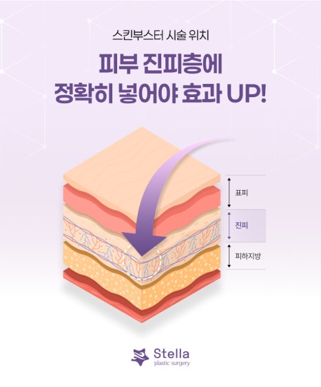 Mok-dong/Omok-gyo Stella Rejuran/Juvelook/Water Glow/Skin Botox: Why Does It Need to Be Properly Delivered into the Dermis During the Procedure? image 3