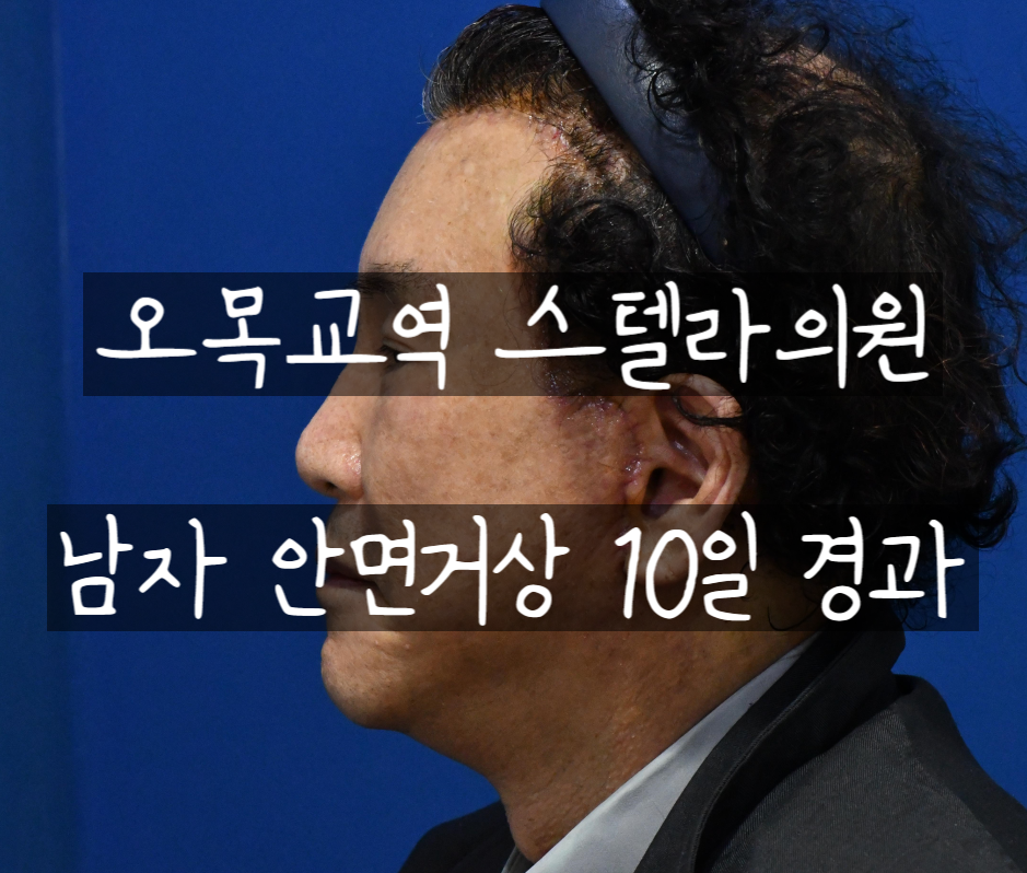 흔한 중년아빠의 안면거상 수술경과? 안면거상 많이하는 병원 관련 이미지 5