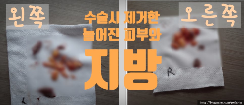 강서구/ 목동 성형외과 50대 남성 눈밑지방재배치 하안검 실밥제거 직후 회복과정 리얼 (전/후) 관련 이미지 4