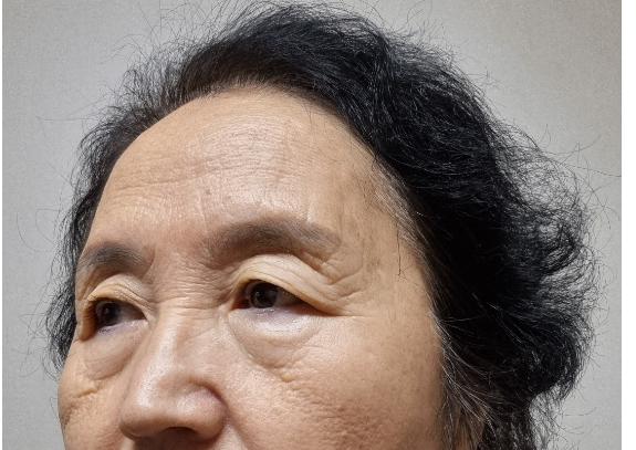 [오목교] 효도성형! 70대 어머님 ,스텔라의원에서 제 2의인생 다시시작하다! 관련 이미지 4