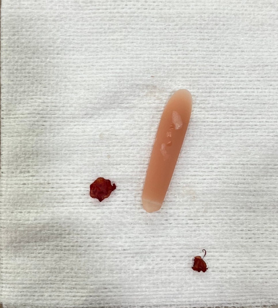 목동성형외과[오목교] 회복빠른 코 실리콘제거 코염증 코보형물 제거 관련 이미지 4