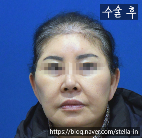 목동 성형 스텔라 #안면거상 재수술 잘하는병원 #안면거상 절개흉터 제거 관련 이미지 4