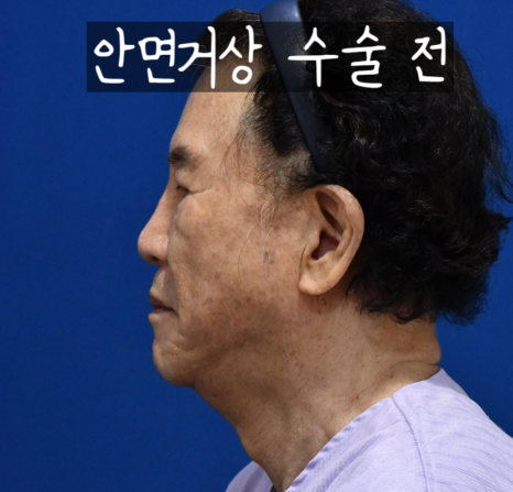 흔한 중년아빠의 안면거상 수술경과? 안면거상 많이하는 병원 관련 이미지 2