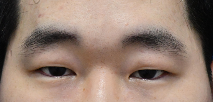 ★ Eyelid Correction Surgery to Improve Eyes That Look Sleepy in Mok-dong / Omokgyo / Yeongdeungpo Plastic Surgery ★ image 1