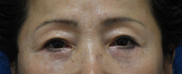 ★목동/영등포/오목교 스텔라의원 눈밑이 볼록해? 하안검지방재배치-2(회복 과정, 주의사항) 관련 이미지 1