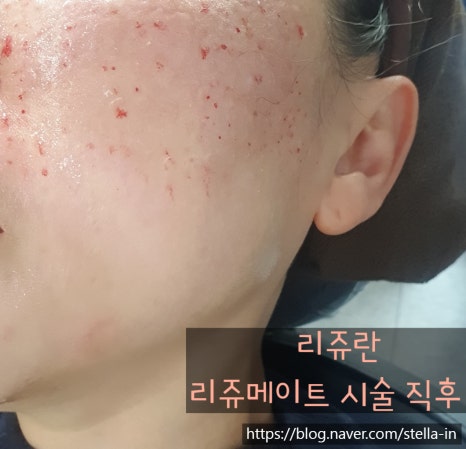 목동 (오목교) 입소문 난 리쥬란주사 회복기간? 관련 이미지 5
