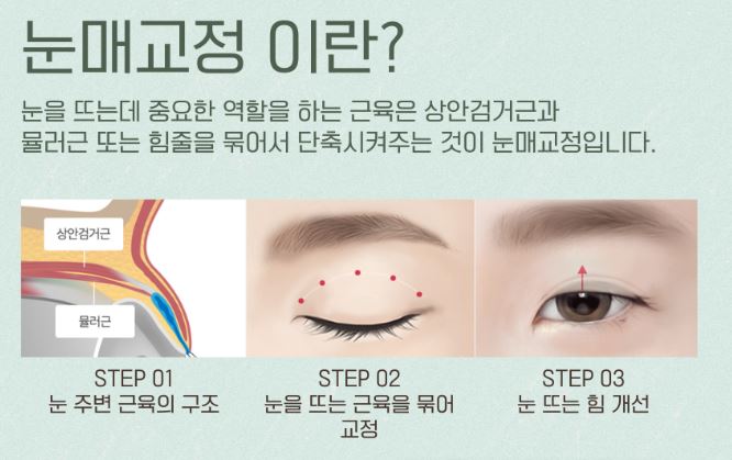 ★ Eyelid Correction Surgery to Improve Eyes That Look Sleepy in Mok-dong / Omokgyo / Yeongdeungpo Plastic Surgery ★ image 2