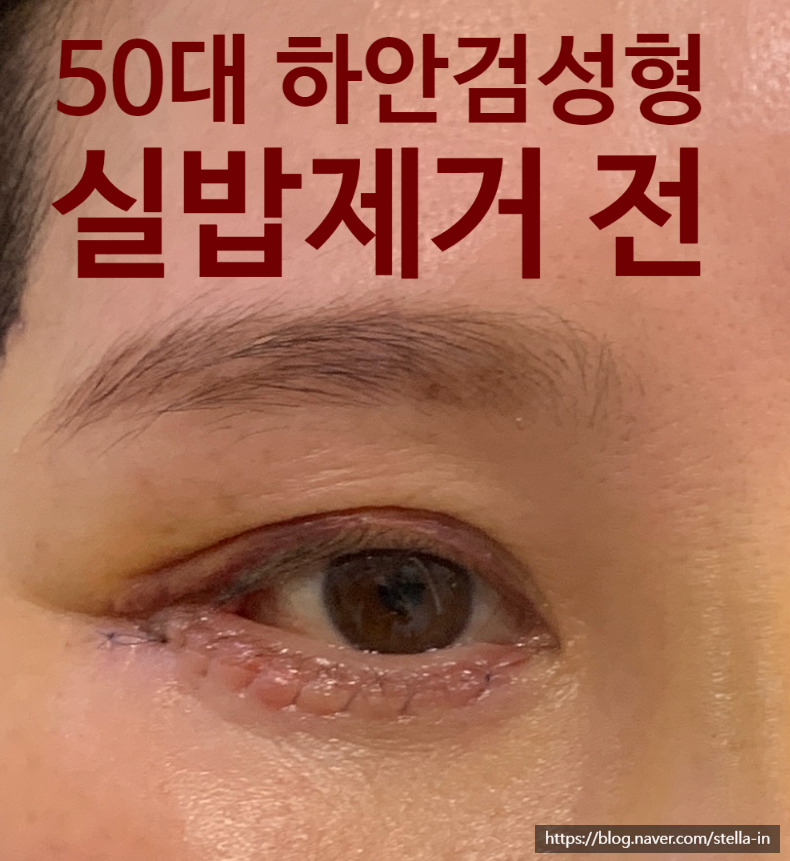 목동 성형외과/오목교 스텔라의원 50대 하안검 수술 회복기간?<리얼사진있습니다!> 관련 이미지 4