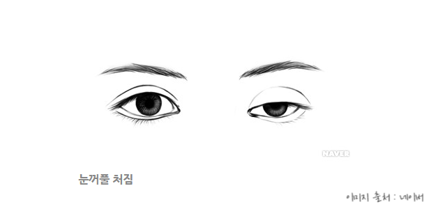 졸려보이는 눈, 안검하수란? 눈매교정에 대해서 알아보자! 관련 이미지 1