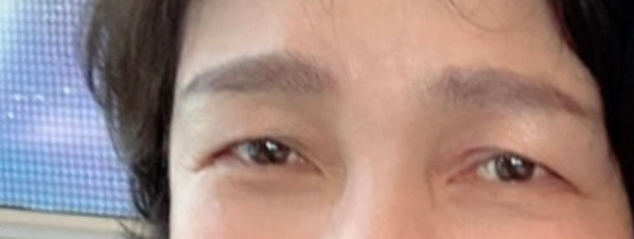 [오목교] 목동 성형외과 스텔라 직원 어머니 !! 60대 눈성형 (전/후) 관련 이미지 1