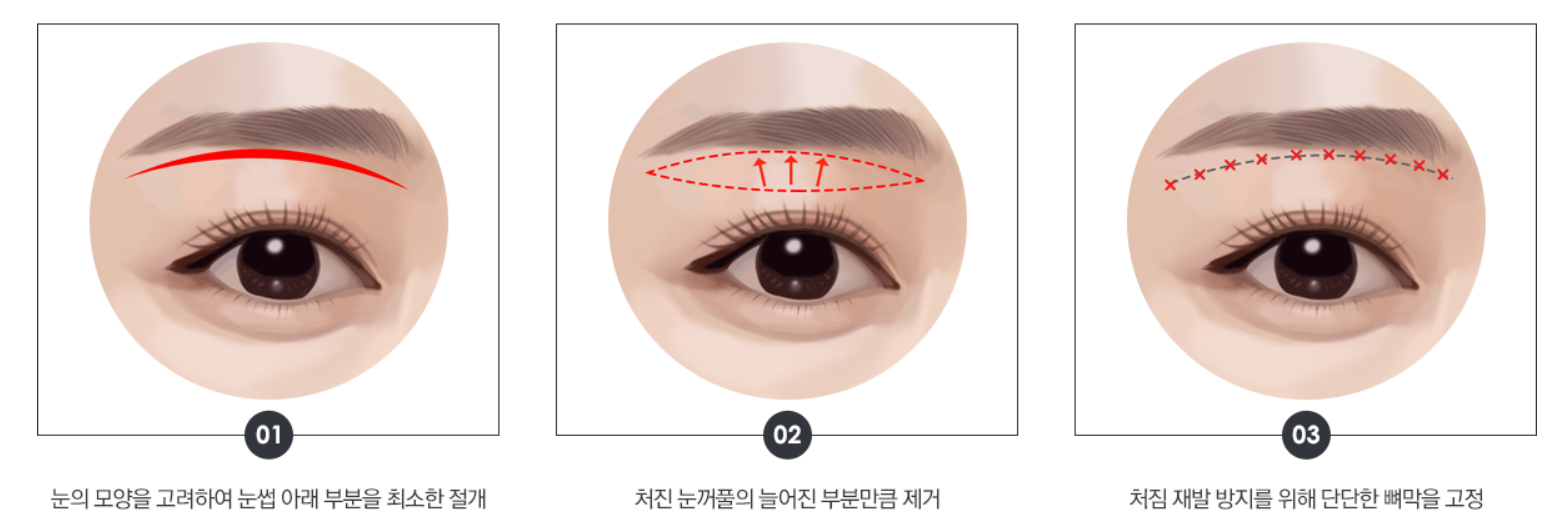 [오목교] 효도성형! 70대 어머님 ,스텔라의원에서 제 2의인생 다시시작하다! 관련 이미지 8