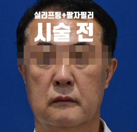 목동 성형외과 스텔라 팔자주름시술  만족도 높은이유? 관련 이미지 3