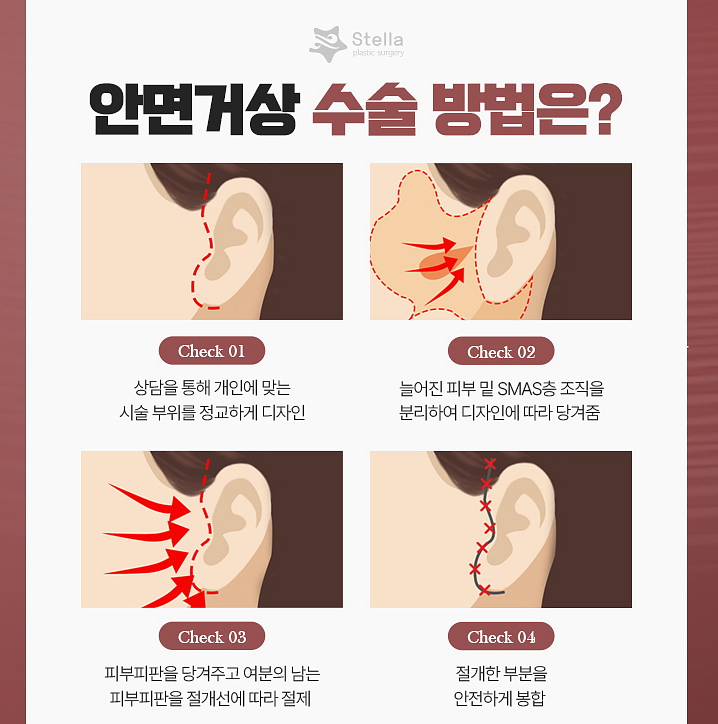 흔한 중년아빠의 안면거상 수술경과? 안면거상 많이하는 병원 관련 이미지 4