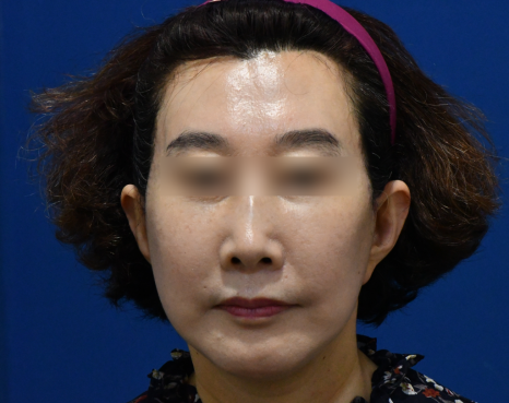 심부볼 처짐 해결 !! 화곡동 안면거상수술의 특별함은?(전/후사진) 관련 이미지 5