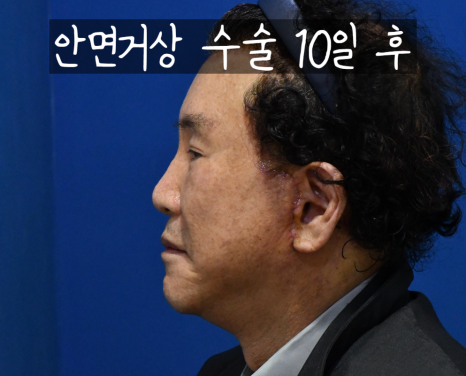 흔한 중년아빠의 안면거상 수술경과? 안면거상 많이하는 병원 관련 이미지 3