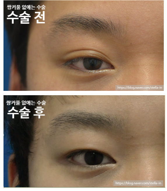 [목동] 남자 무쌍 수술 / 남자 쌍수 / 쌍커풀없애는수술 ( 전/후사진 有) 관련 이미지 3