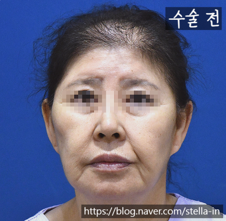 목동 성형 스텔라 #안면거상 재수술 잘하는병원 #안면거상 절개흉터 제거 관련 이미지 3
