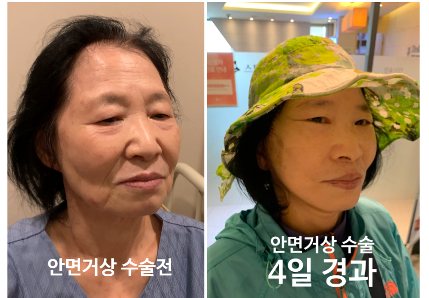 안면거상수술 과정 과 안면거상 회복기간 리얼영상 /오목교 스텔라 관련 이미지 1