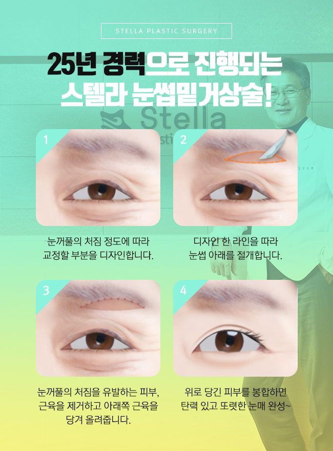 60대 눈처짐 수술후 인상이 강해보일까봐 걱정이라면? 관련 이미지 2