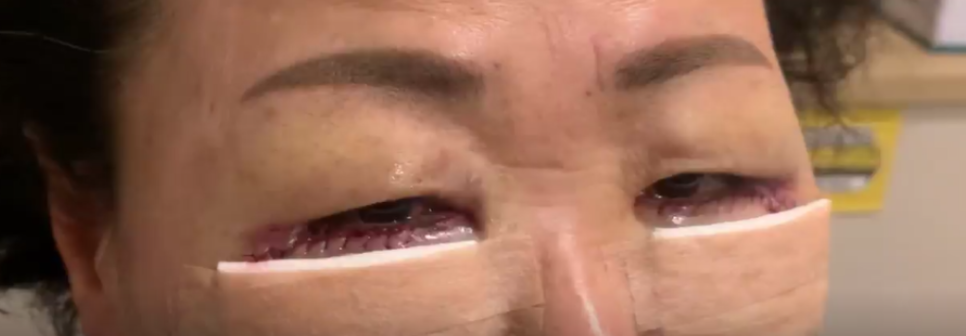 목동 성형외과/오목교 스텔라의원 50대 하안검 수술 회복기간?<리얼사진있습니다!> 관련 이미지 3