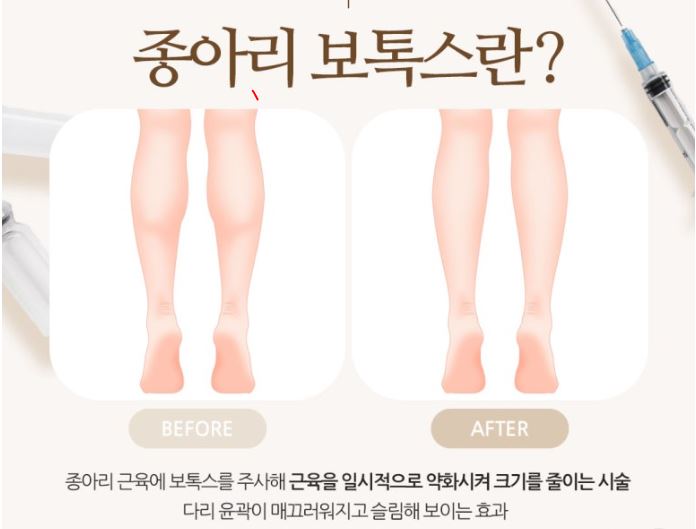 * Botulinum Toxin for Calves at a Plastic Surgery Clinic in Mok-dong / Omokgyo / Yeongdeungpo / Dangsan / Yangcheon * image 1