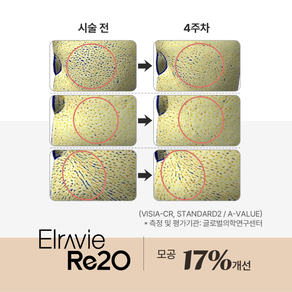 목동/영등포/여의도 스텔라의원★ 리투오or리쥬란 효과/회복/유지기간 비교 관련 이미지 5
