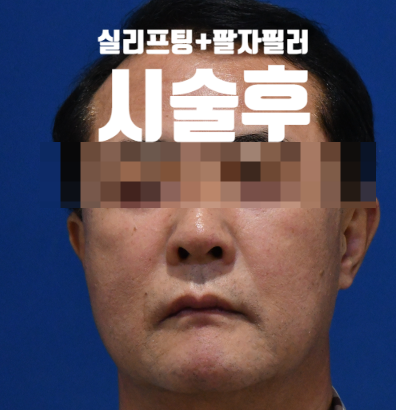 목동 성형외과 스텔라 팔자주름시술  만족도 높은이유? 관련 이미지 4