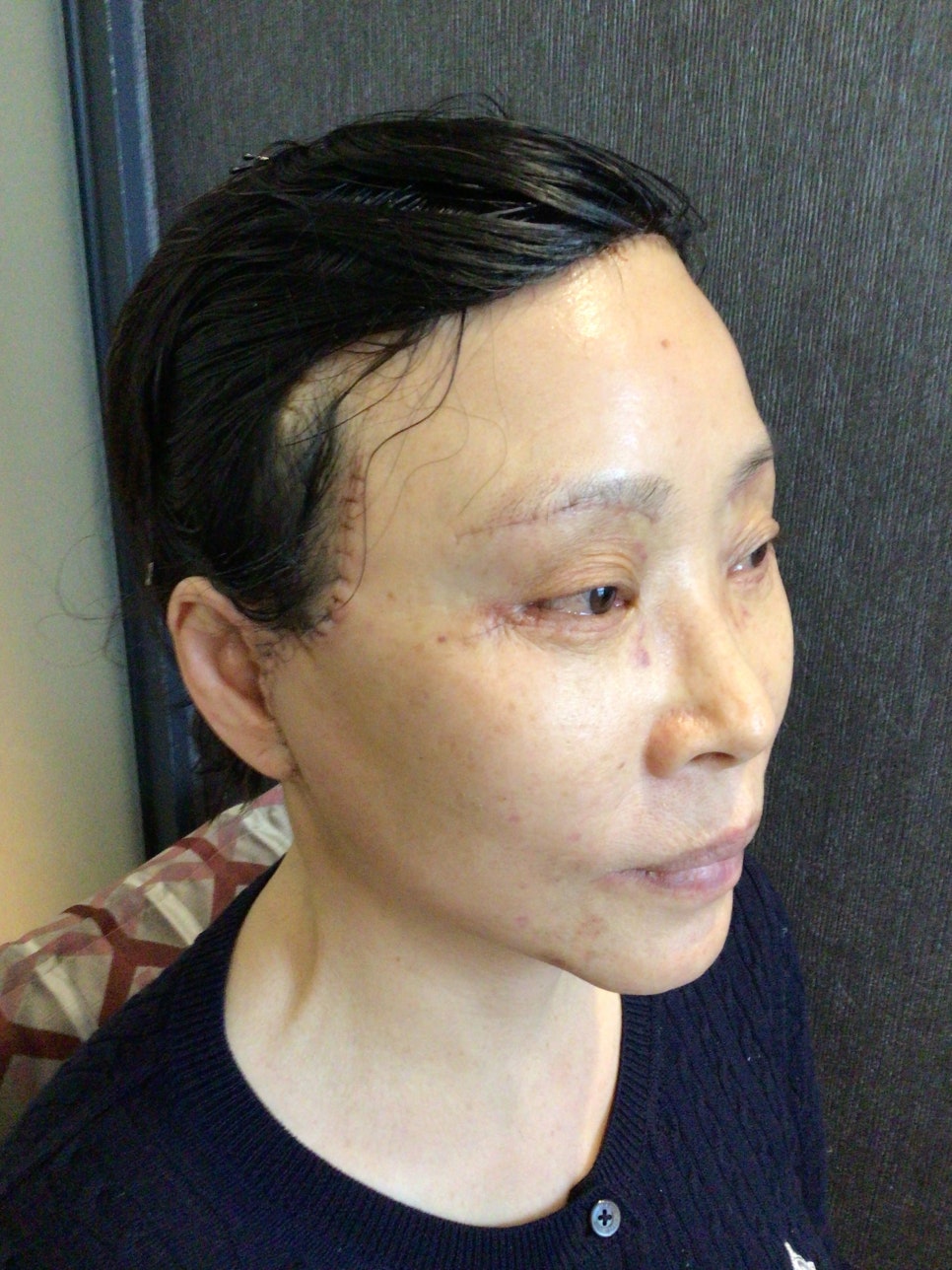 눈상담 받으러 왔다가 풀안면거상까지 하게된 60대중반 중년 어머님 (전/후) /목동 성형외과 스텔라성형 관련 이미지 19