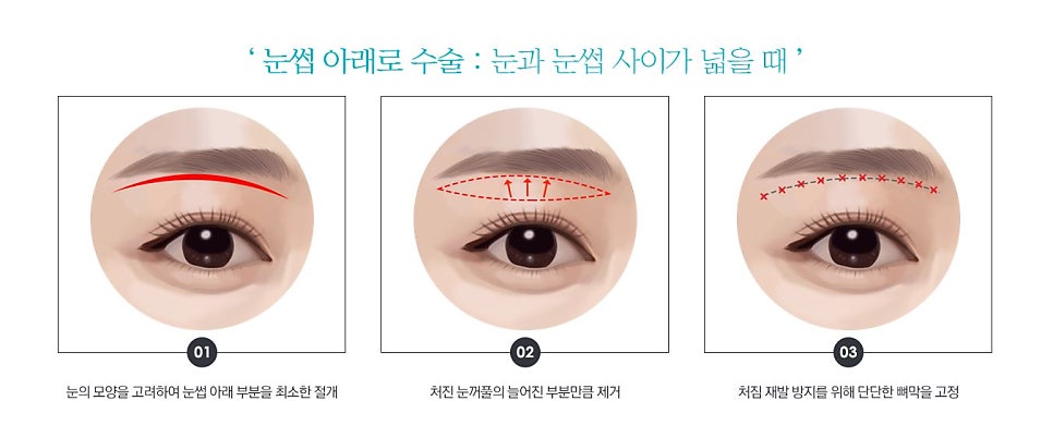 ★목동/오목교/영등포 스텔라성형외과 중년 성형 눈썹밑거상 관련 이미지 1