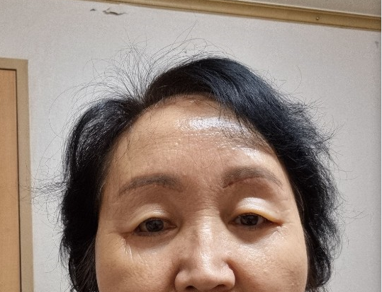 [오목교] 효도성형! 70대 어머님 ,스텔라의원에서 제 2의인생 다시시작하다! 관련 이미지 5