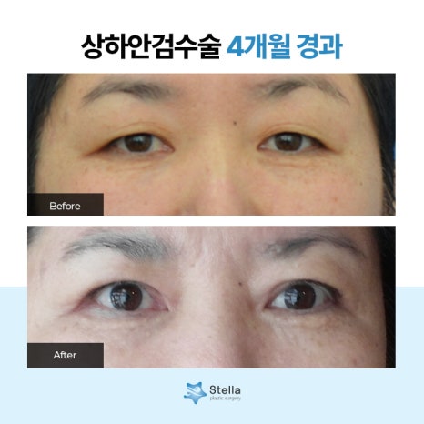 눈 수술 후, 빠른회복을 위한 방법은 ??  스텔라가 알려드릴게요!  (오목교 스텔라성형외과) 관련 이미지 7