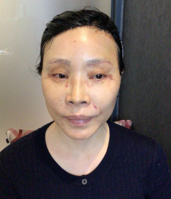 눈상담 받으러 왔다가 풀안면거상까지 하게된 60대중반 중년 어머님 (전/후) /목동 성형외과 스텔라성형 관련 이미지 18