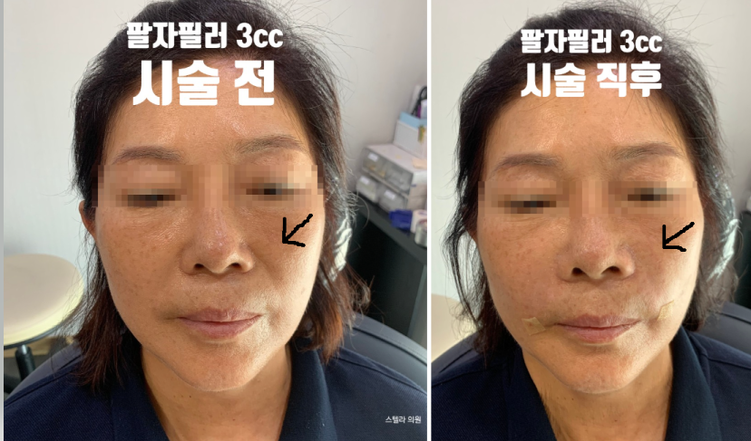 목동 성형외과 스텔라 팔자주름시술  만족도 높은이유? 관련 이미지 2
