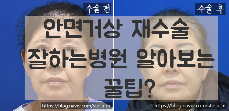 목동 성형 스텔라 #안면거상 재수술 잘하는병원 #안면거상 절개흉터 제거 관련 이미지 2
